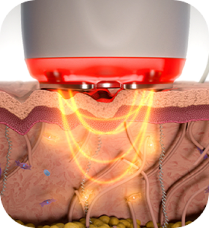 ルチポーラーRFによる加熱