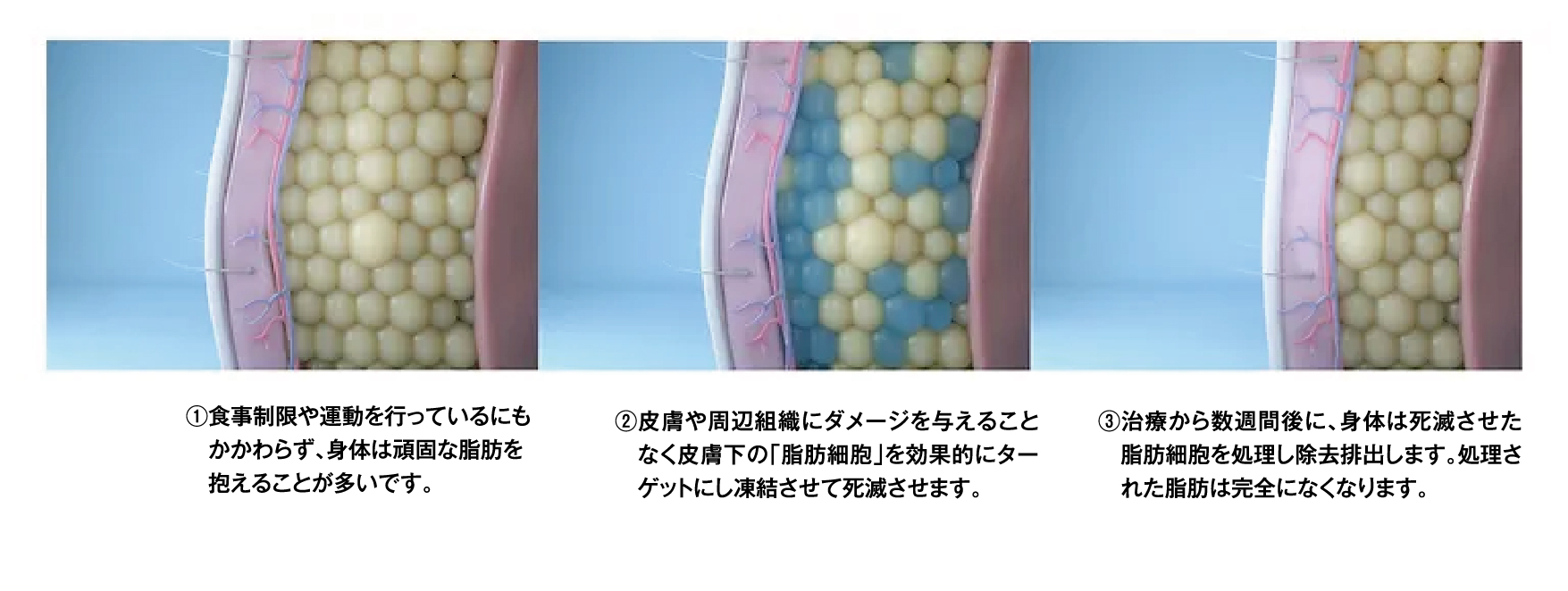 グラマースノエル効果画像