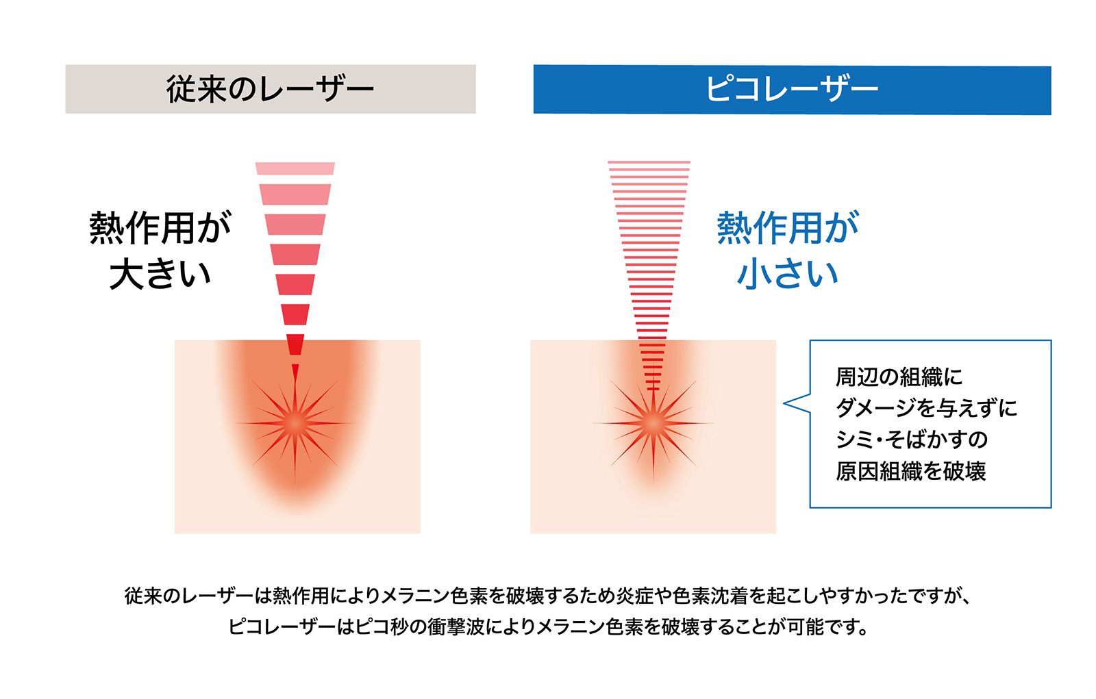 ピコレーザー(PQX)