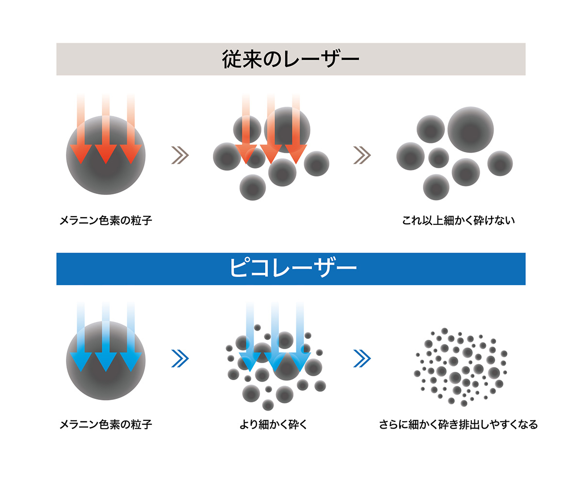 ピコレーザー(PQX)
