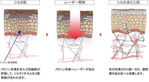 シミ治療にQスイッチルビーレーザー